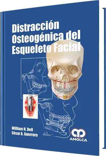 Distracción Osteogénica del Esqueleto Facial