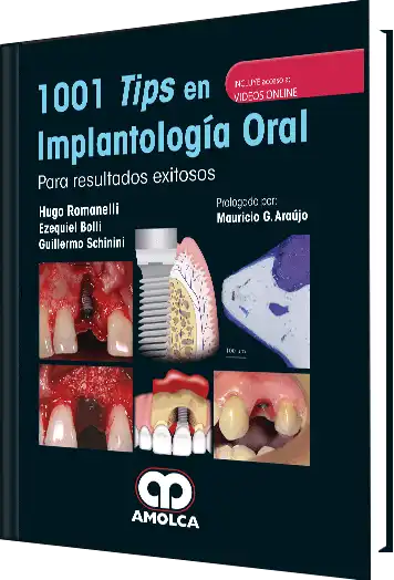 1001 Tips en Implantología Oral